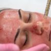 “Vampire facials” advanced by celebs are connected to new HIV cases