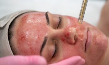 “Vampire facials” advanced by celebs are connected to new HIV cases